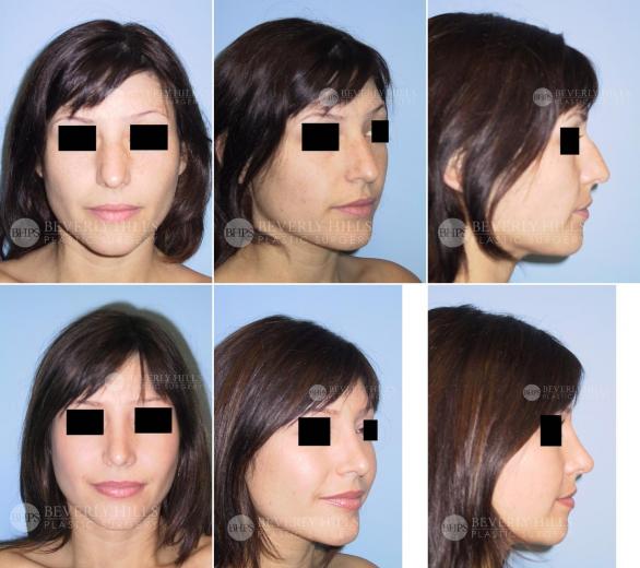Beverly Hills Plastic Surgery gallery image 375