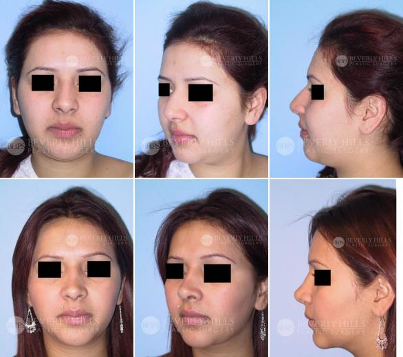 Beverly Hills Plastic Surgery gallery image 376