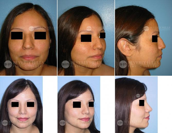 Beverly Hills Plastic Surgery gallery image 378