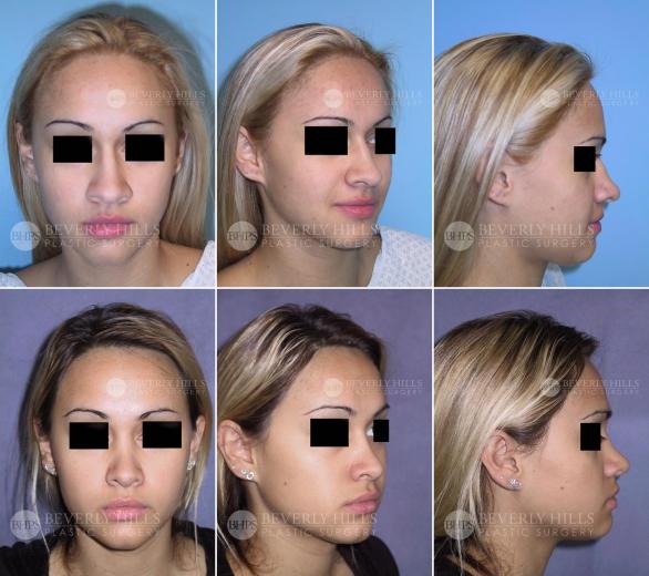 Beverly Hills Plastic Surgery gallery image 379