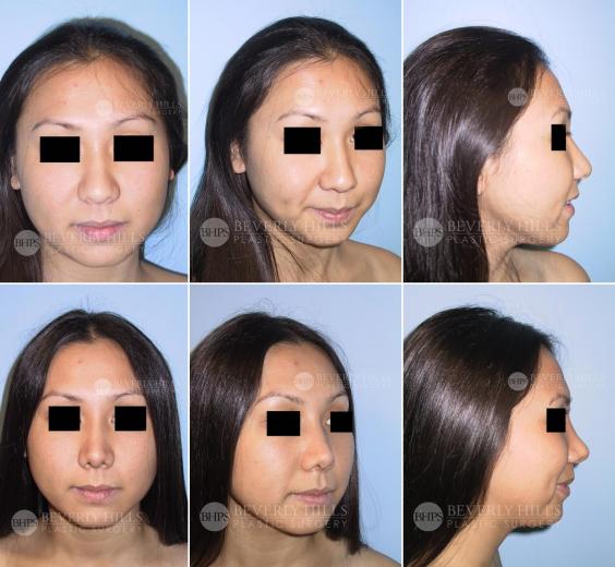 Beverly Hills Plastic Surgery gallery image 384
