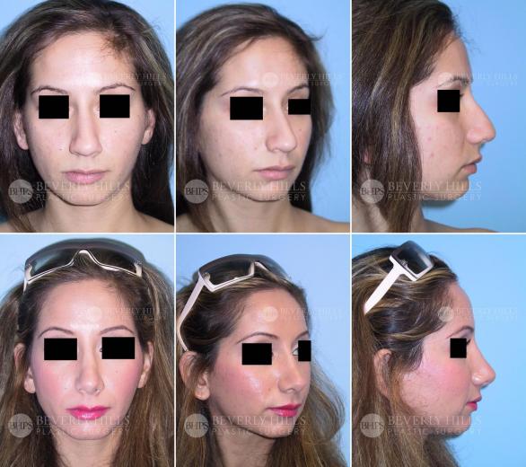 Beverly Hills Plastic Surgery gallery image 388