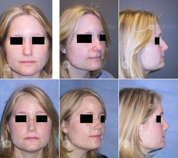 Beverly Hills Plastic Surgery gallery image 389