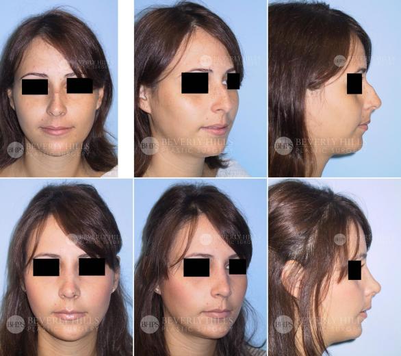 Beverly Hills Plastic Surgery gallery image 390