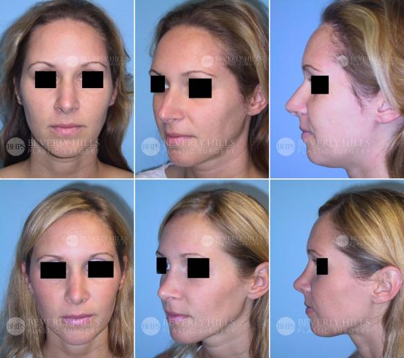 Beverly Hills Plastic Surgery gallery image 393