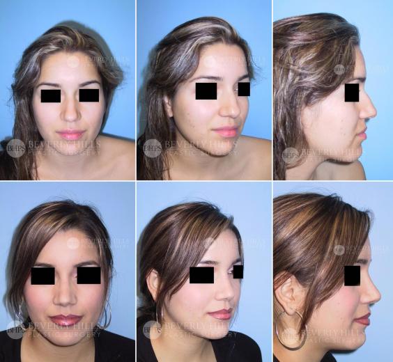 Beverly Hills Plastic Surgery gallery image 394