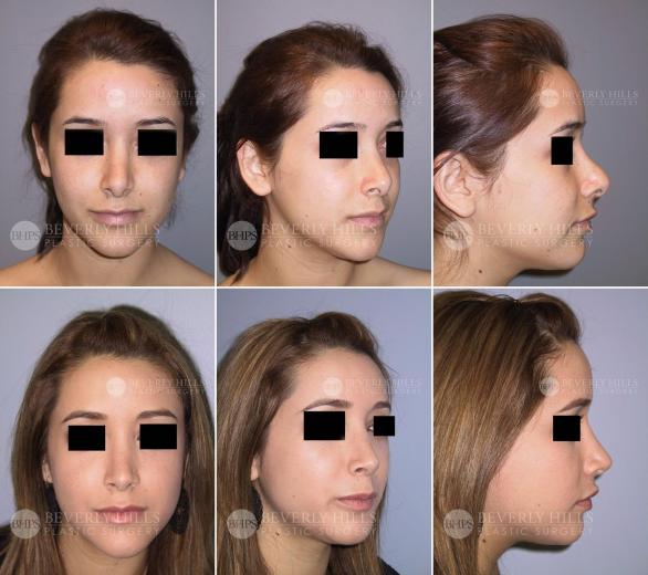 Beverly Hills Plastic Surgery gallery image 396