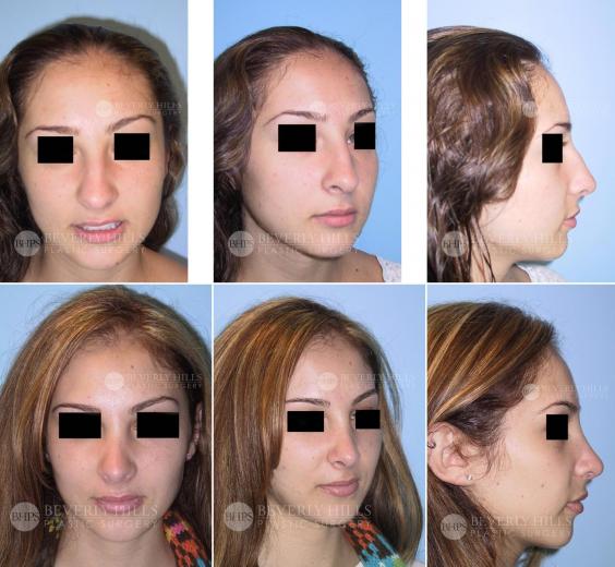 Beverly Hills Plastic Surgery gallery image 397