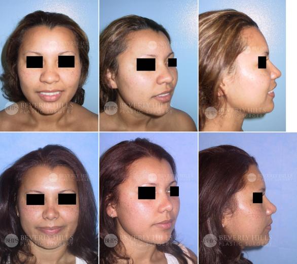 Beverly Hills Plastic Surgery gallery image 398