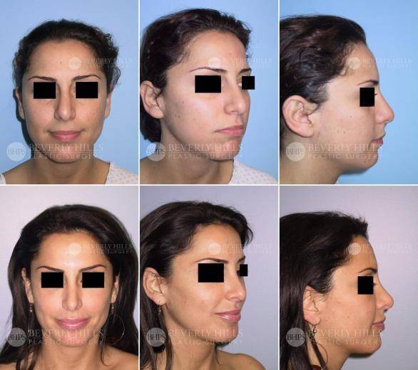 Beverly Hills Plastic Surgery gallery image 401