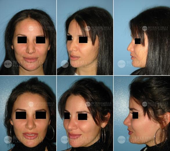 Beverly Hills Plastic Surgery gallery image 404