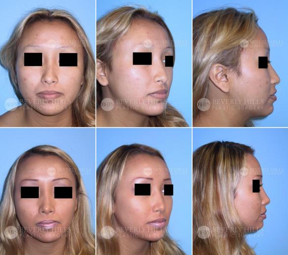 Beverly Hills Plastic Surgery gallery image 406
