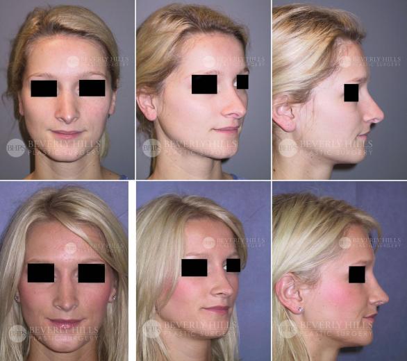 Beverly Hills Plastic Surgery gallery image 407
