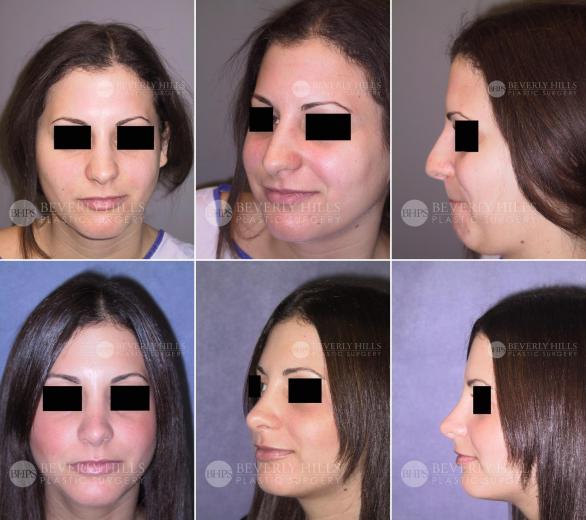 Beverly Hills Plastic Surgery gallery image 408