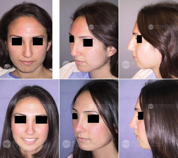 Beverly Hills Plastic Surgery gallery image 409