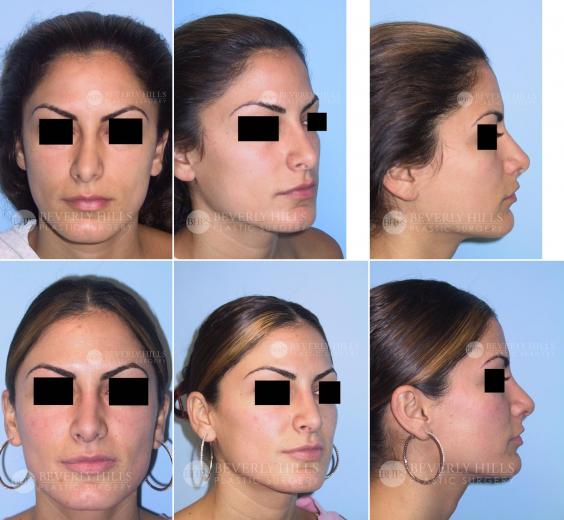 Beverly Hills Plastic Surgery gallery image 410