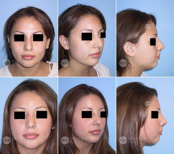 Beverly Hills Plastic Surgery gallery image 411