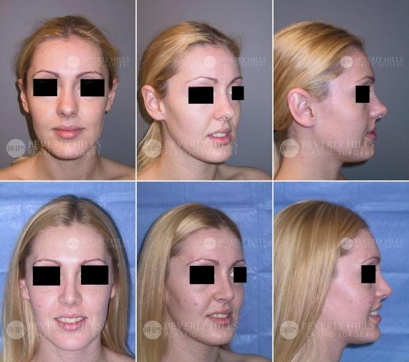 Beverly Hills Plastic Surgery gallery image 413