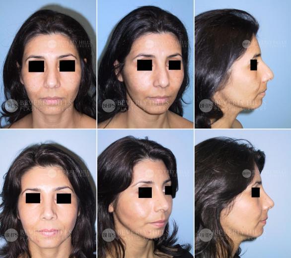 Beverly Hills Plastic Surgery gallery image 414