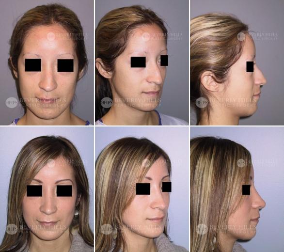 Beverly Hills Plastic Surgery gallery image 415