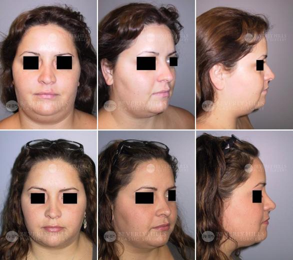 Beverly Hills Plastic Surgery gallery image 416