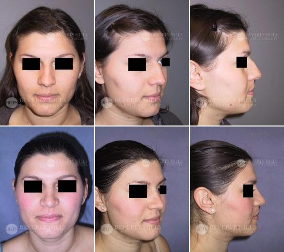 Beverly Hills Plastic Surgery gallery image 418