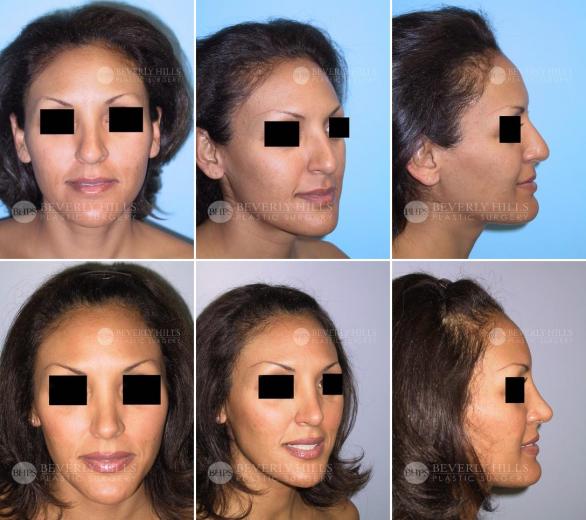 Beverly Hills Plastic Surgery gallery image 419