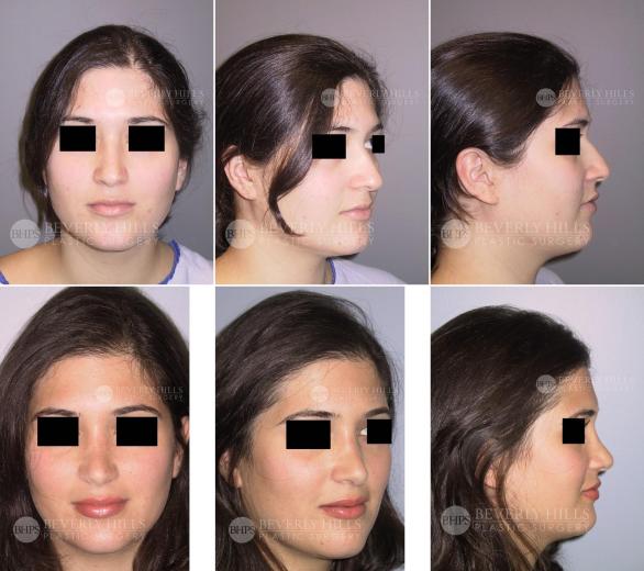 Beverly Hills Plastic Surgery gallery image 424