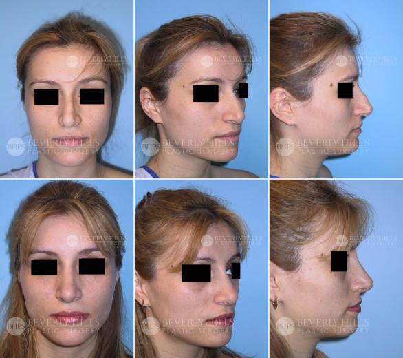 Beverly Hills Plastic Surgery gallery image 426