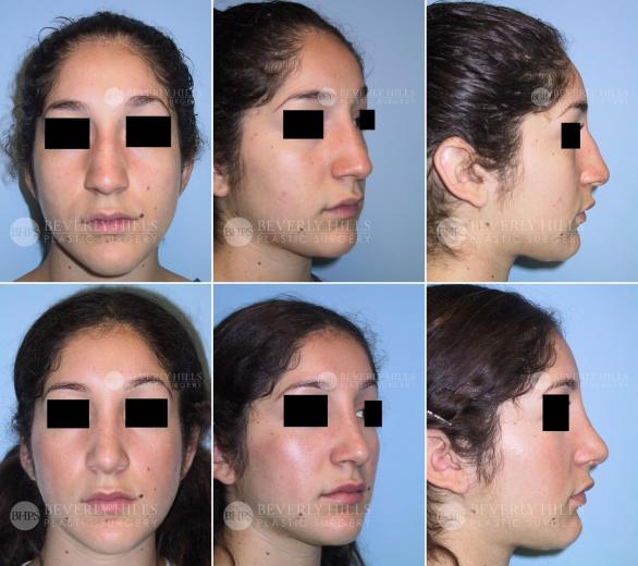 Beverly Hills Plastic Surgery gallery image 427