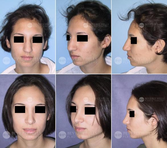 Beverly Hills Plastic Surgery gallery image 429