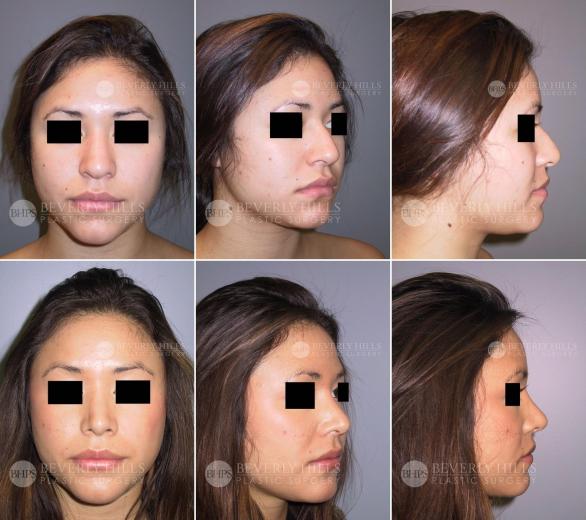 Beverly Hills Plastic Surgery gallery image 430