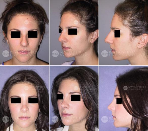 Beverly Hills Plastic Surgery gallery image 431