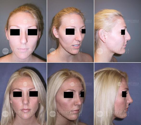 Beverly Hills Plastic Surgery gallery image 432