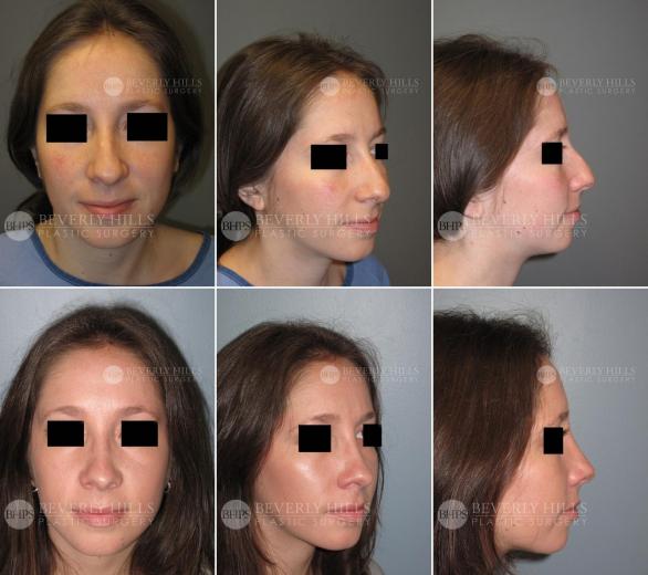 Beverly Hills Plastic Surgery gallery image 434