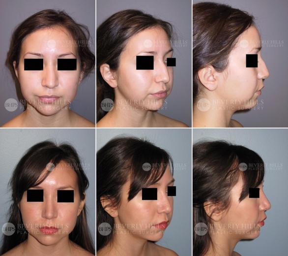 Beverly Hills Plastic Surgery gallery image 435