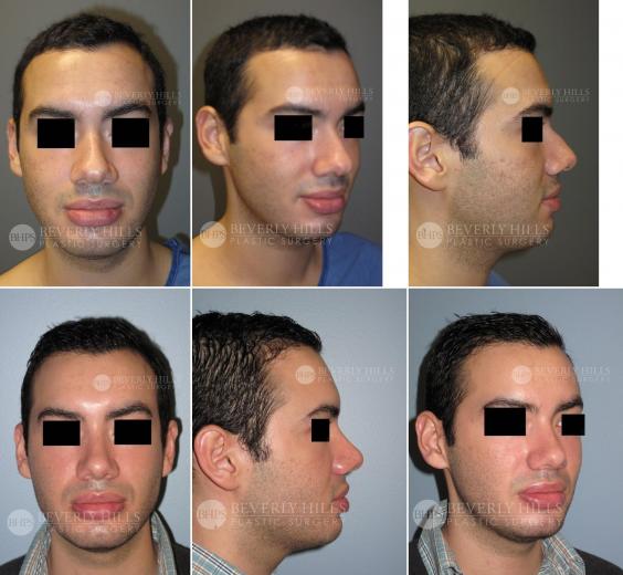 Beverly Hills Plastic Surgery gallery image 436