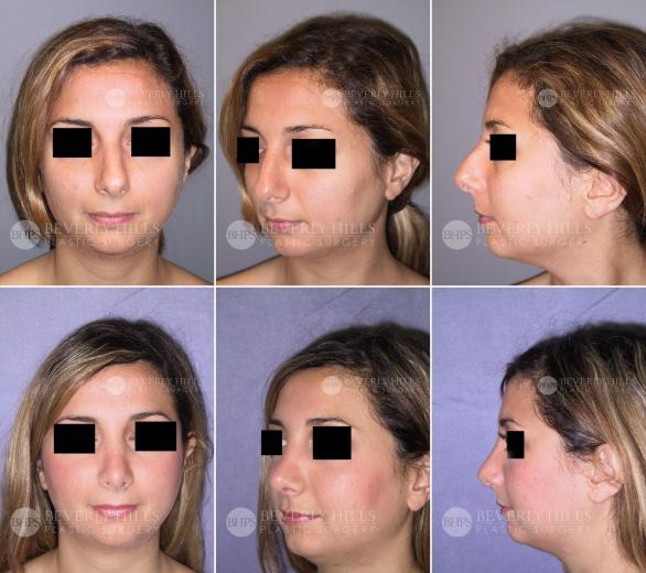 Beverly Hills Plastic Surgery gallery image 437