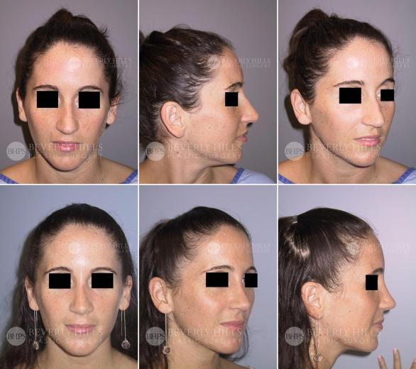 Beverly Hills Plastic Surgery gallery image 438