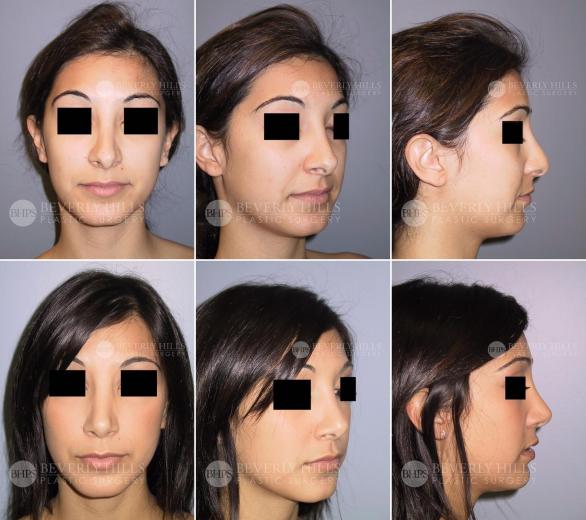 Beverly Hills Plastic Surgery gallery image 439