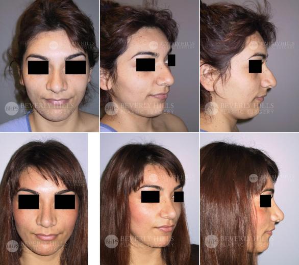 Beverly Hills Plastic Surgery gallery image 441