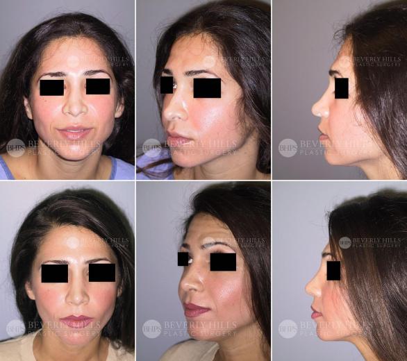 Beverly Hills Plastic Surgery gallery image 442
