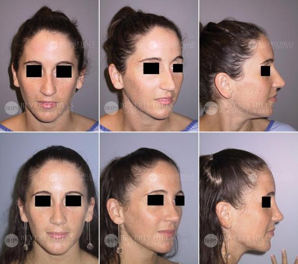 Beverly Hills Plastic Surgery gallery image 443