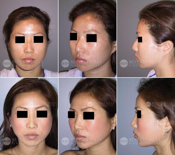 Beverly Hills Plastic Surgery gallery image 444