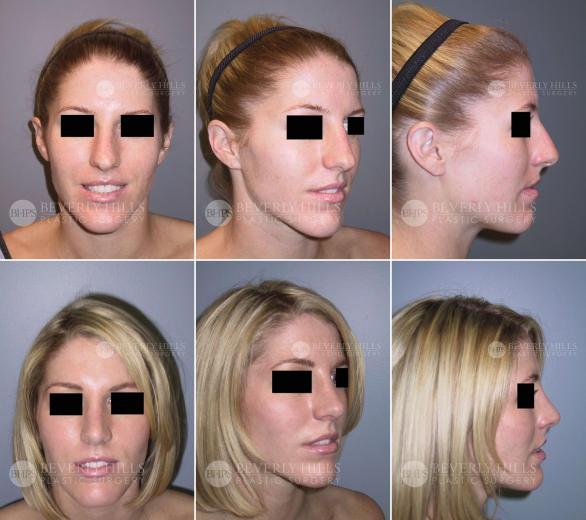 Beverly Hills Plastic Surgery gallery image 445