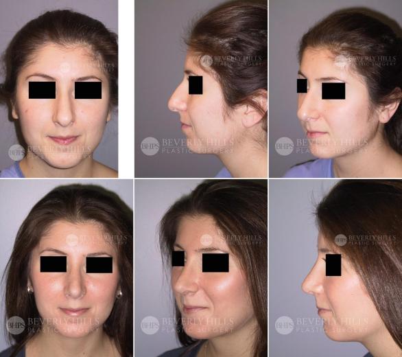 Beverly Hills Plastic Surgery gallery image 447