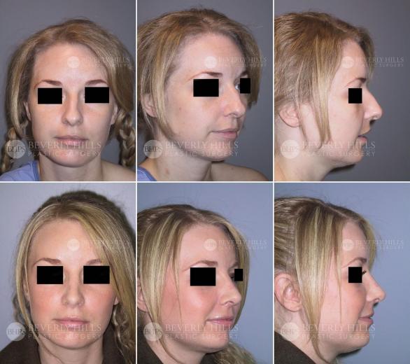 Beverly Hills Plastic Surgery gallery image 452