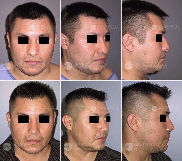 Beverly Hills Plastic Surgery gallery image 456
