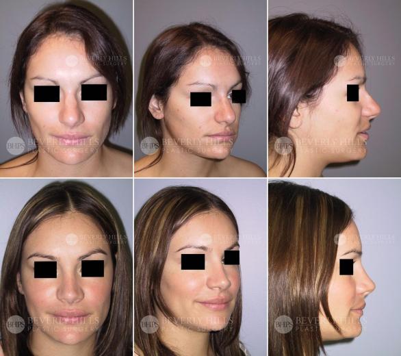 Beverly Hills Plastic Surgery gallery image 457