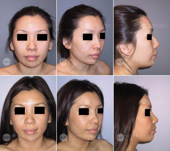 Beverly Hills Plastic Surgery gallery image 458
